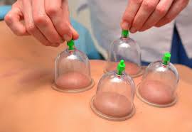 cupping 2